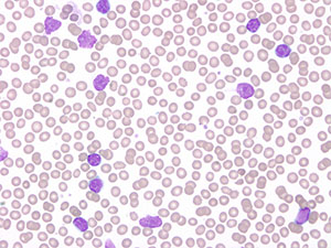 Chronic Lymphocytic Leukemia pb2