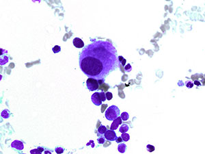 Myelodysplastic Syndrome 5q-2