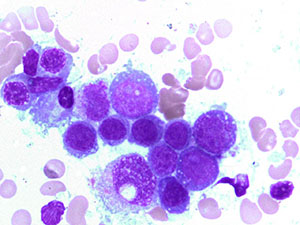 Myelodysplastic Syndrome blasts3