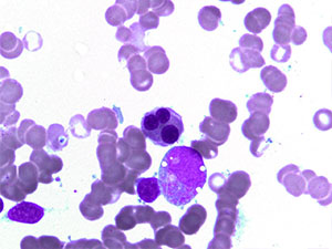 Myelodysplastic Syndrome dyse1