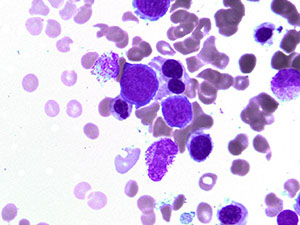 Myelodysplastic Syndrome dyse4