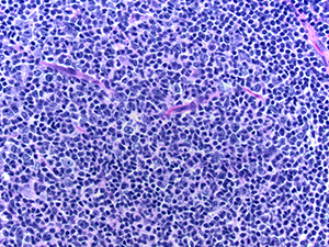 Non-Hodgkin Lymphoma 40x HE 3