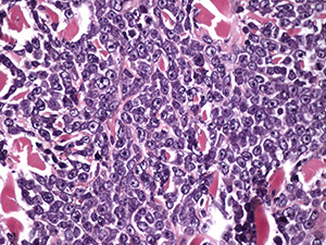 Non-Hodgkin Lymphoma slide