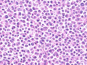 Plasma Cell Myeloma pltoma2